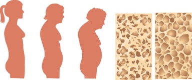 What is osteoporosis?