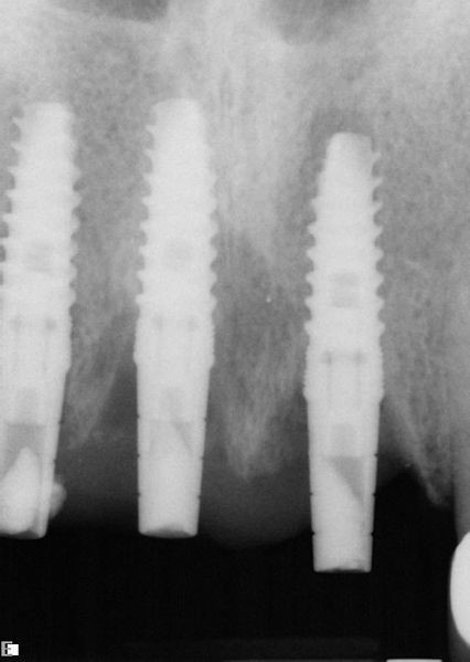 The procedure for dental implants